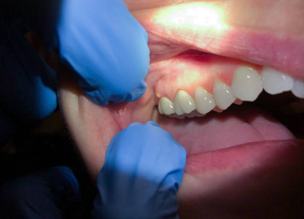 Best Knocked-Out Tooth (Avulsed Tooth) Treatment in Frankl, IN